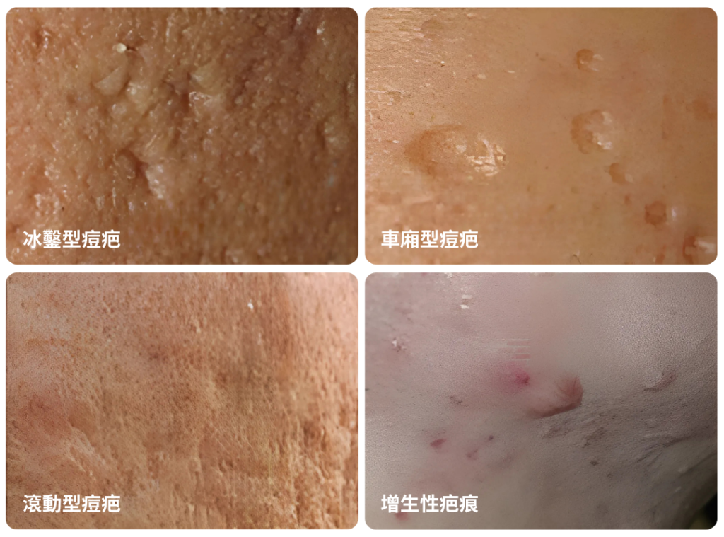 痘疤種類