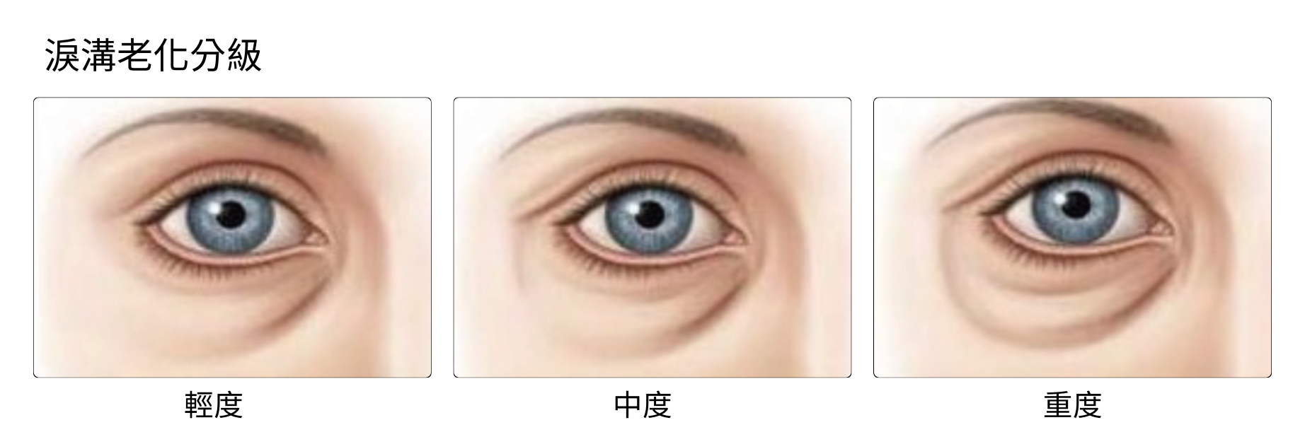 淚溝老化分級
