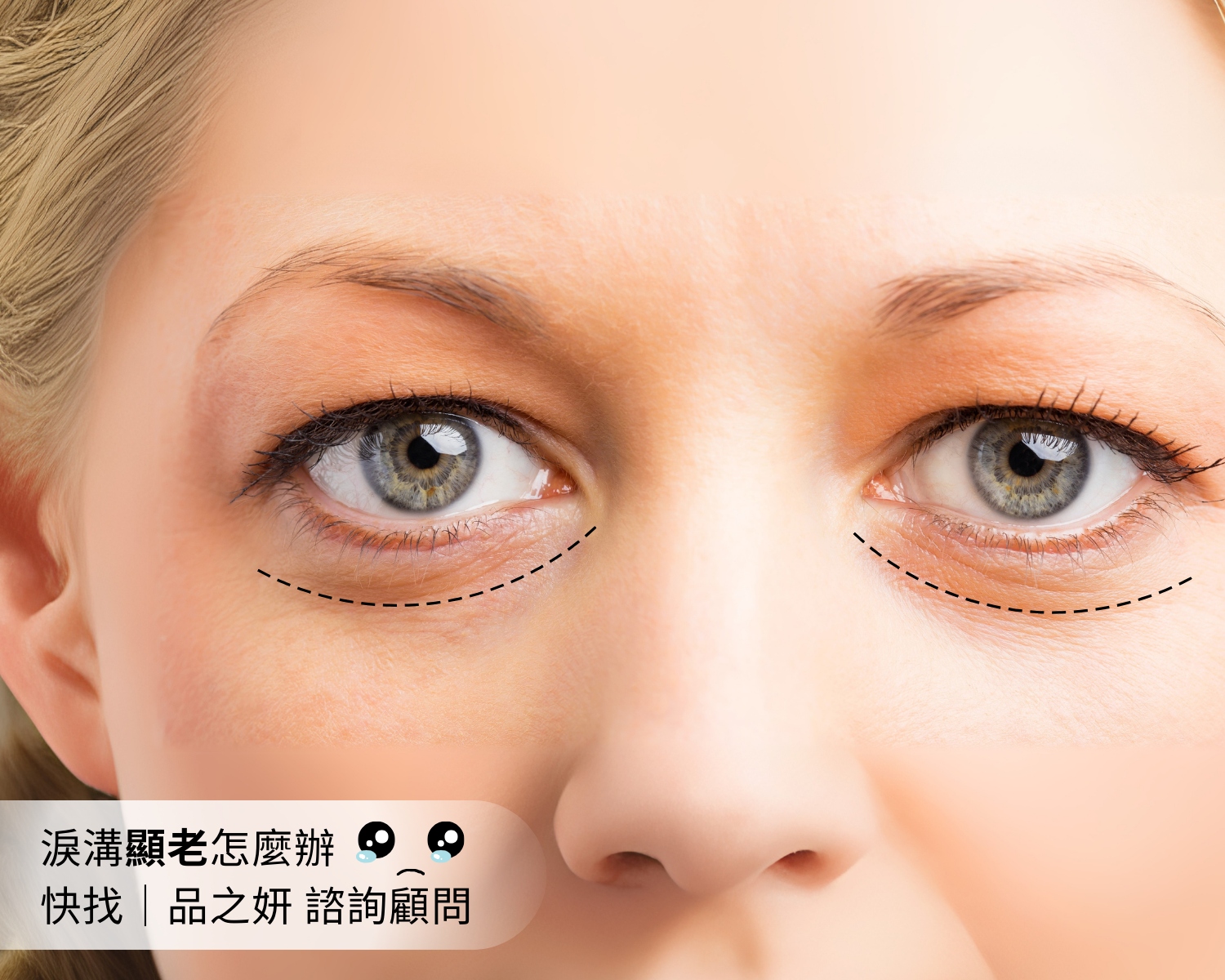 淚溝顯老怎麼辦 (1)