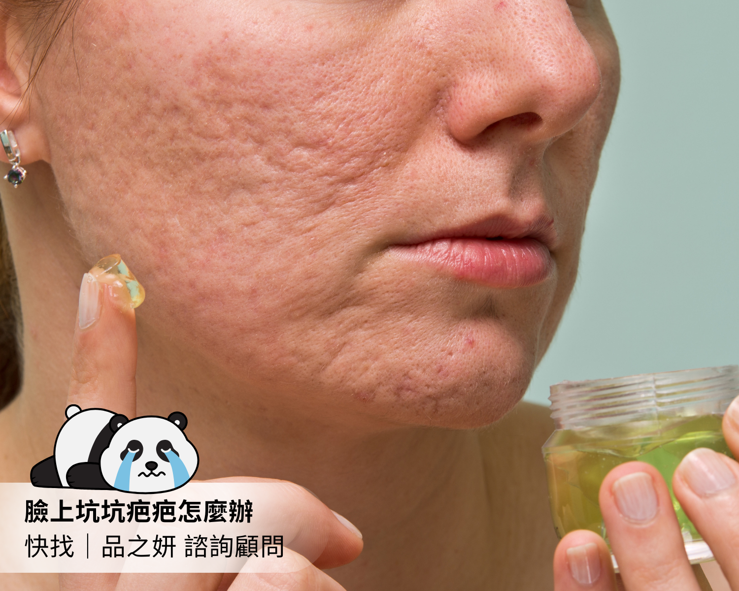 痘疤在臉上怎麼辦 (1)