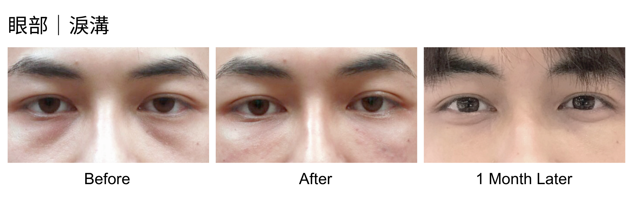 眼部｜淚溝