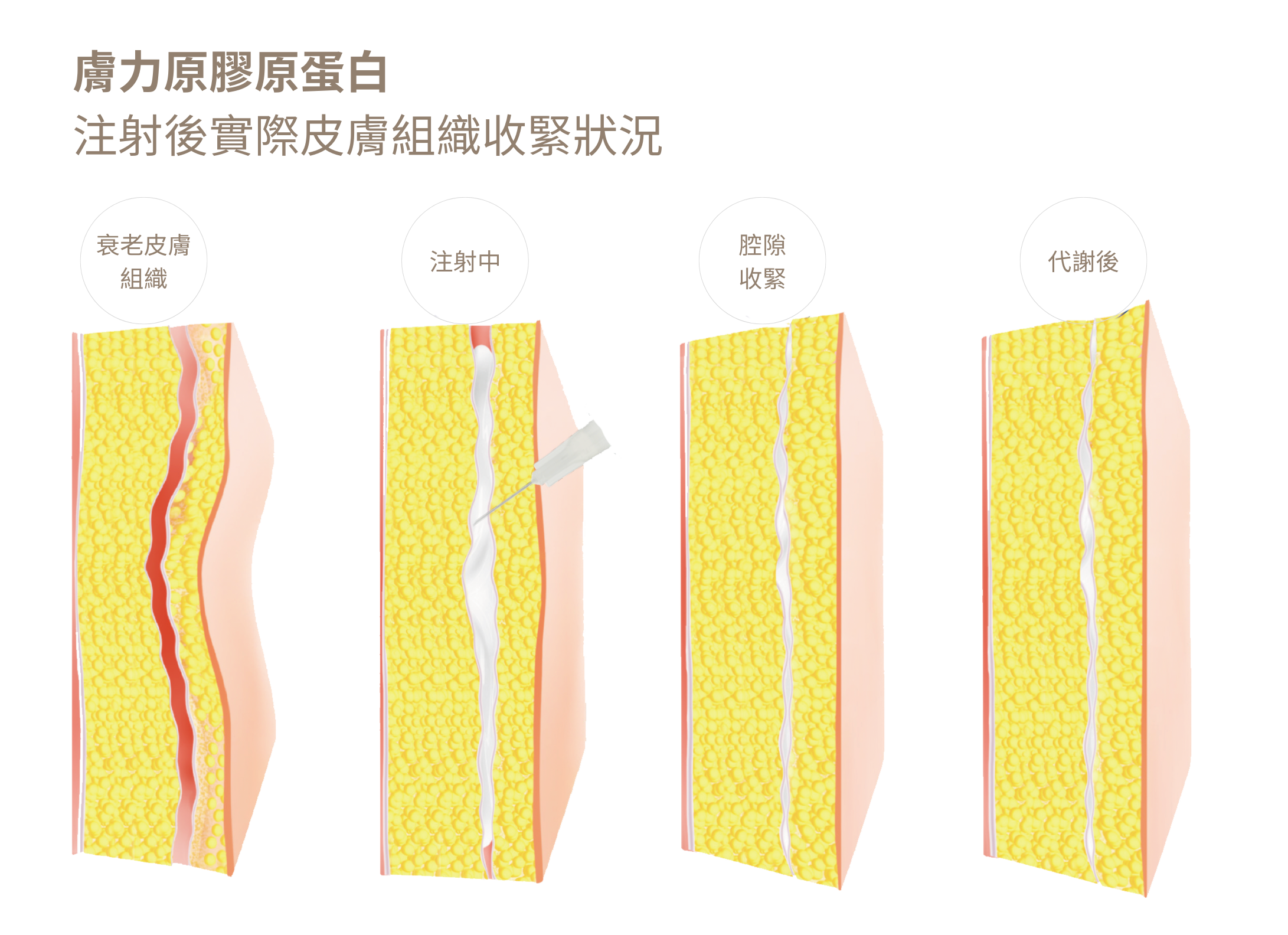 膚力原膠原蛋白注射