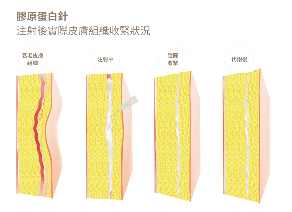 膠原蛋白針注射