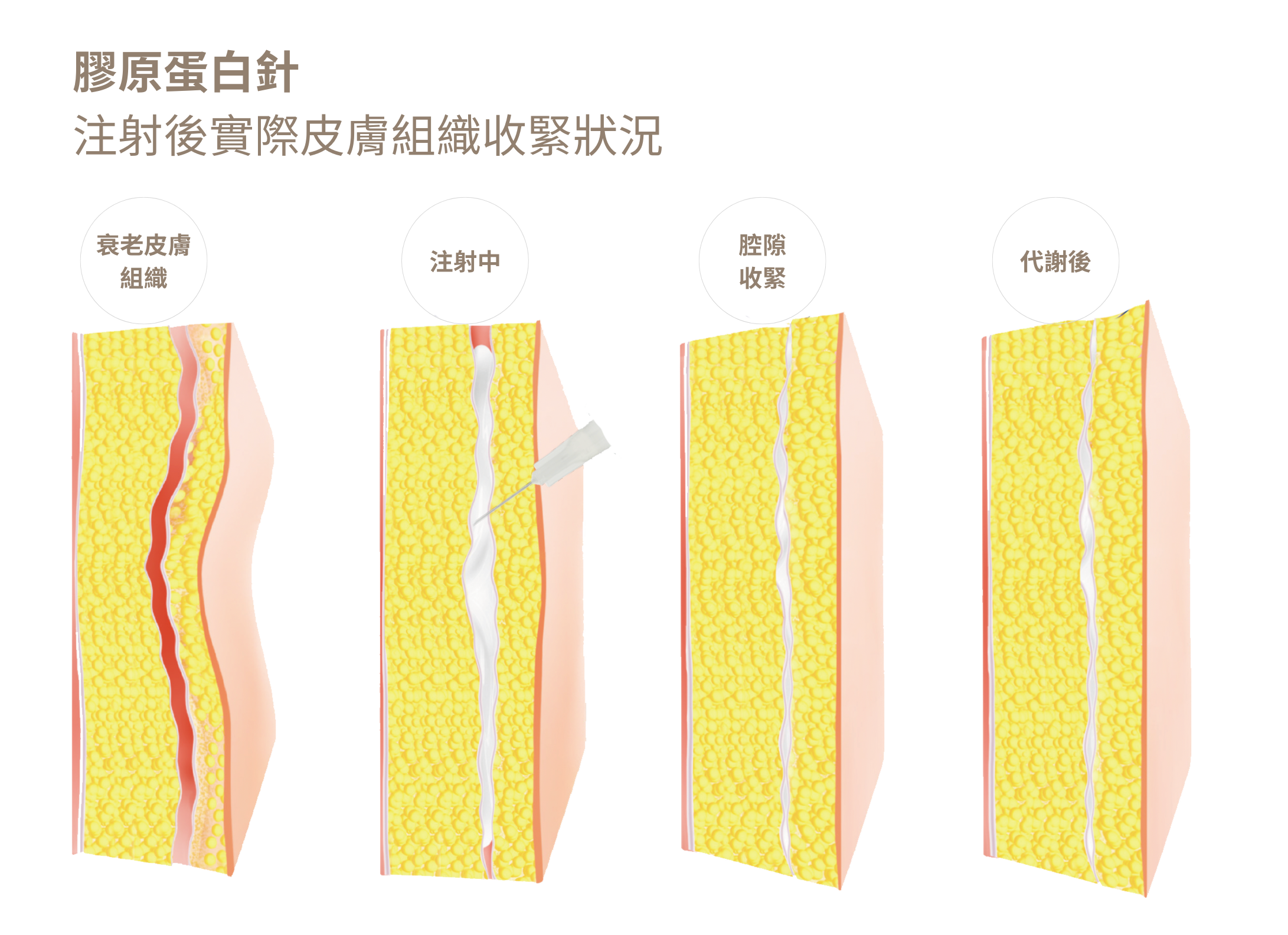 膠原蛋白針注射