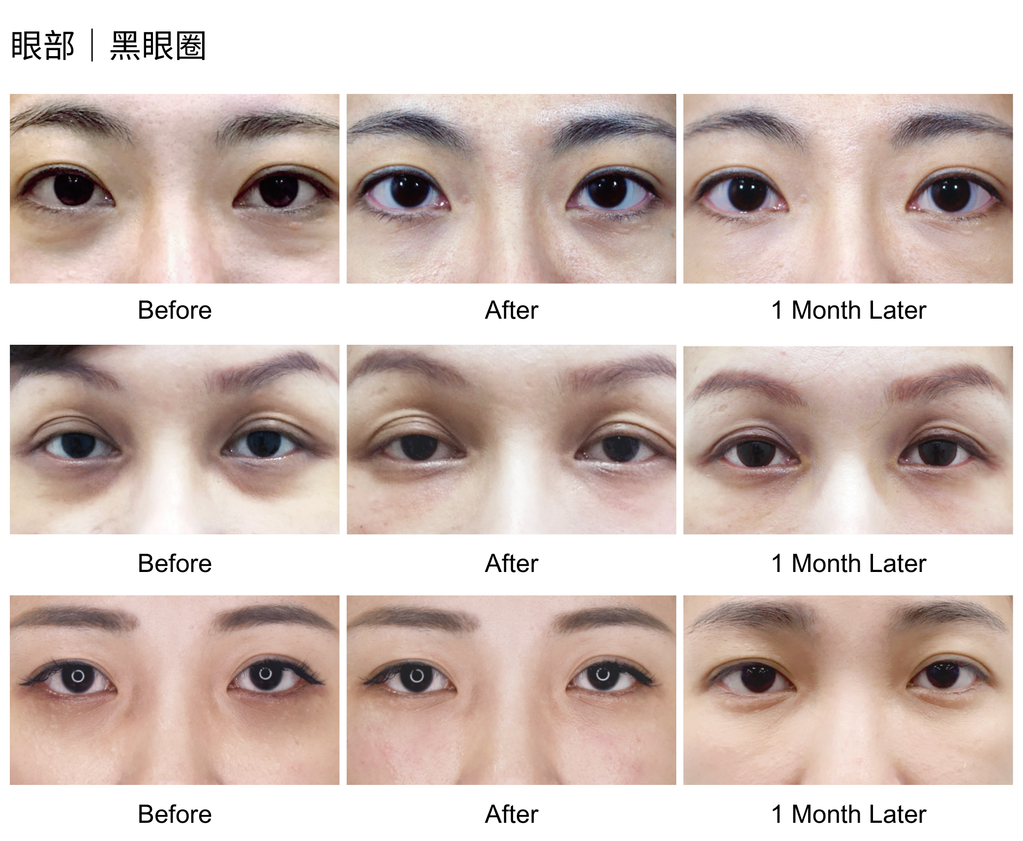 黑眼圈改善範例